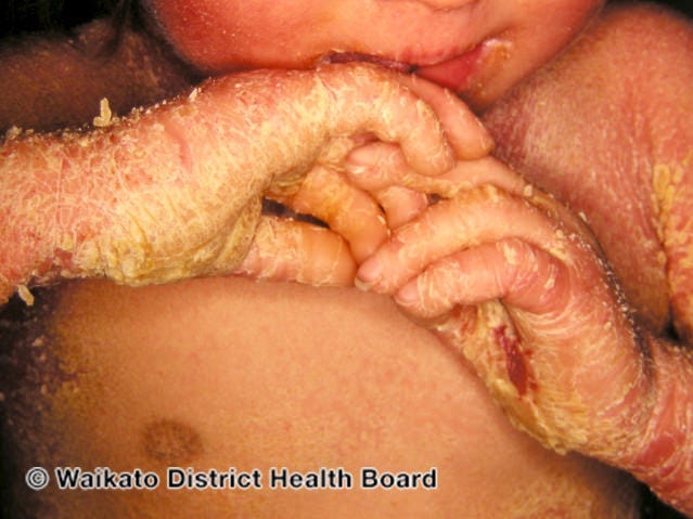 Picture of a young child with epidermolytic ichthyosis, mainly showing their hands.
