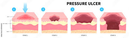 Bedsores pressure ulcer injury skin ...