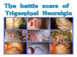 Trigeminal Neuralgia Support New Zealand - Givealittle