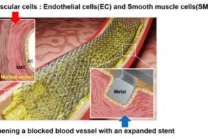 Expanded stent physically opens a blocked blood vessel, but interactions between the metal surface and vascular cells can either promote healing or lead to adverse effects.