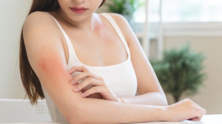 link between vitamin d and psoriasis