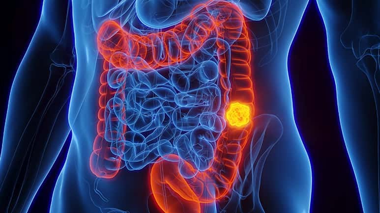 gut bacteria colon cancer risk