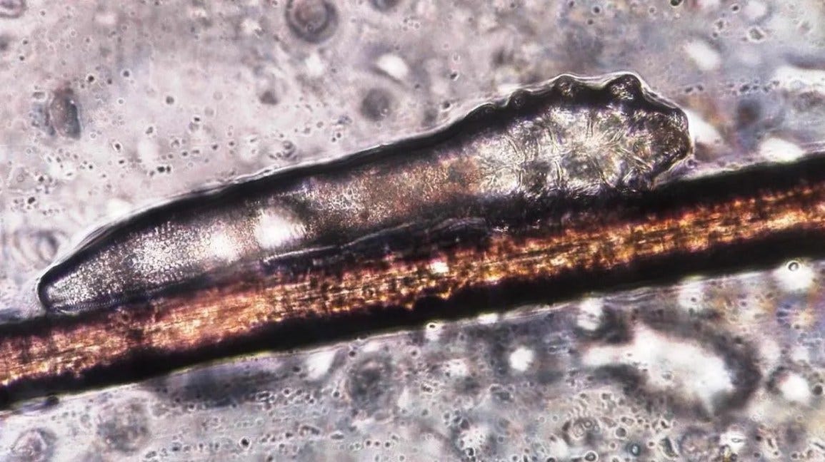 Demodex folliculorum: Causes, symptoms, and treatment