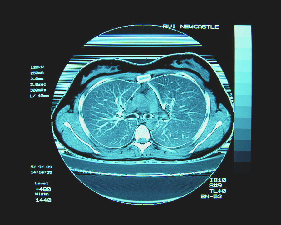 Ct Scan Of Chest Showing Lungs Photograph by Simon Fraser/science Photo ...