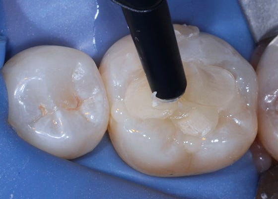 Placing Posterior Composite: Paving the Way to Restorative Success - 3M  Dental Blog