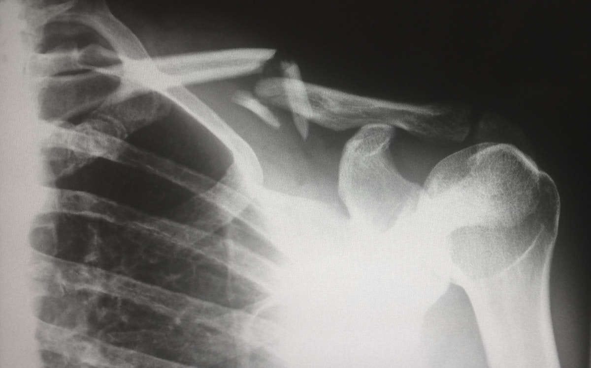 Imagem em preto e branco de uma radiografia mostrando um ombro fraturado.