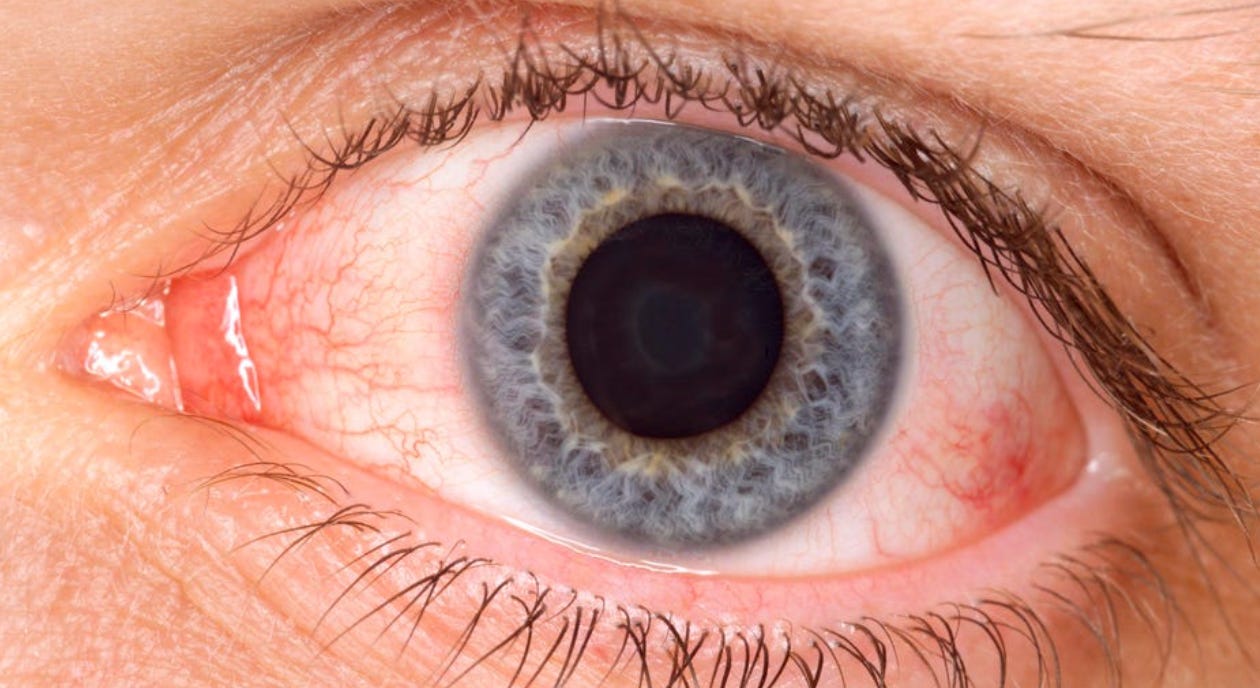 What To Know About 'Arcturus': New Covid Variant Causing Pink Eye | The  Transmission | University of Nebraska Medical Center
