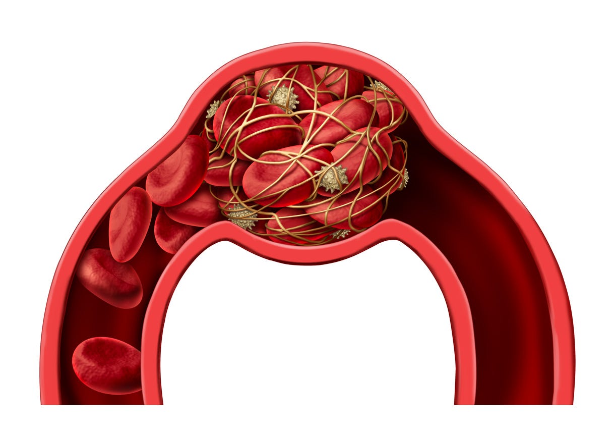 What Are the Signs of a Blood Clot?