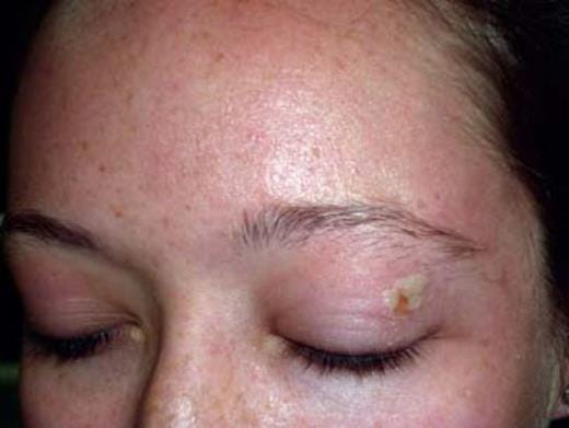 Dermatitis with pustulation of the eyelid.