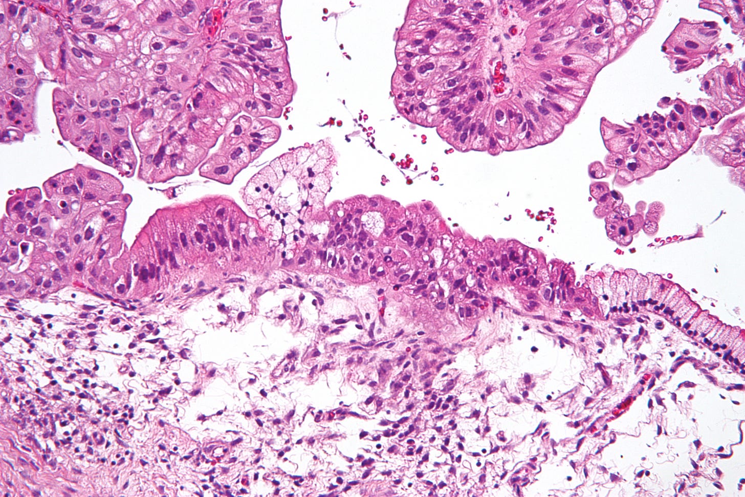 Ovarian cancer - Wikipedia