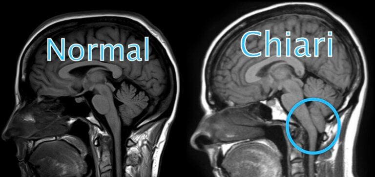 Chiari malformation