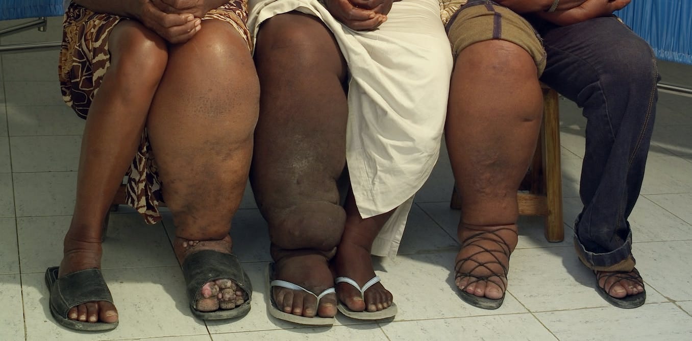 Why it's hard to end elephantiasis, a debilitating disease spread by  mosquitoes