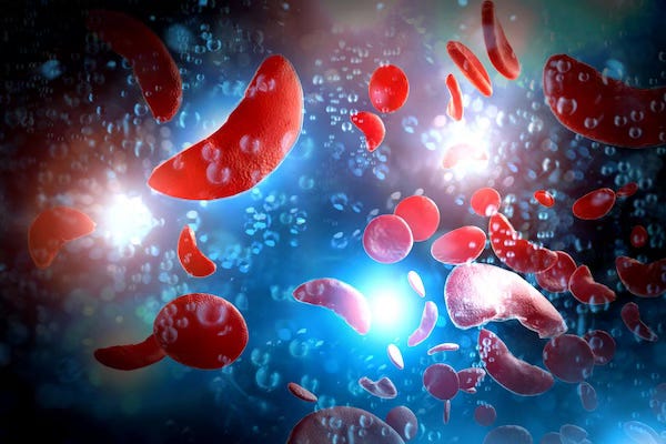3D rendering of sickle cell anemia