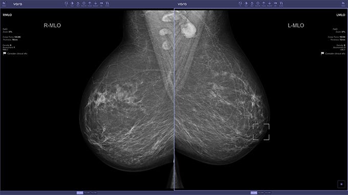 X-ray images of a person's breasts as viewed through an AI-enabled image viewer. A white square highlights a region in one image that the AI suspects might be cancerous.