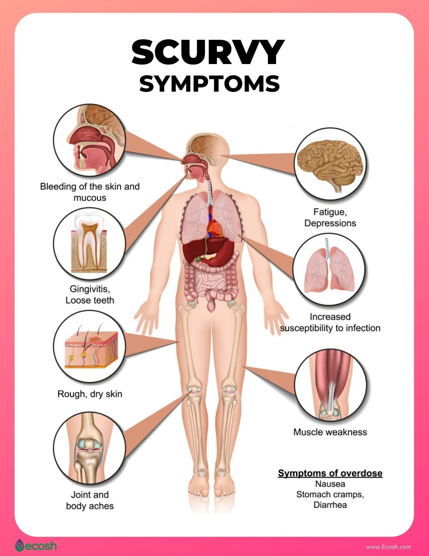 SCURVY (VITAMIN C DEFICIENCY) - Symptoms, Causes, Risk Factors and Treatment - Ecosh