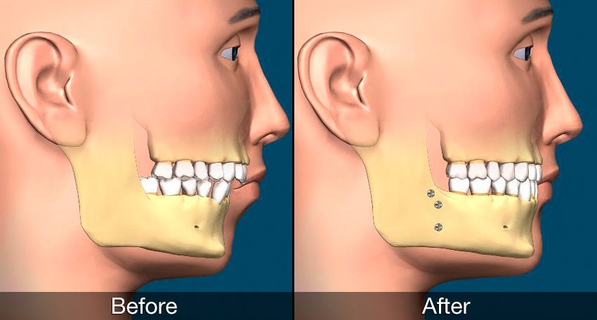 Orthognathic (Corrective Jaw) Surgery & Genioplasty (Chin surgery) | Gold  Coast Oral Maxillofacial & Implant Surgery