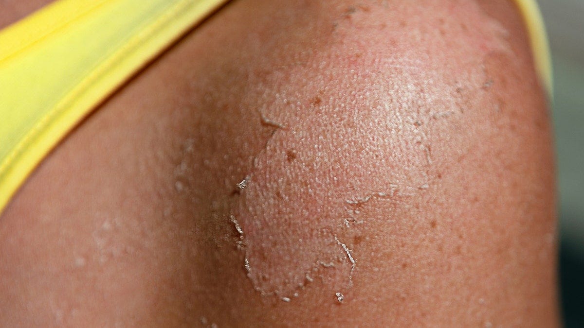 Peeling skin on the shoulder after sunburn