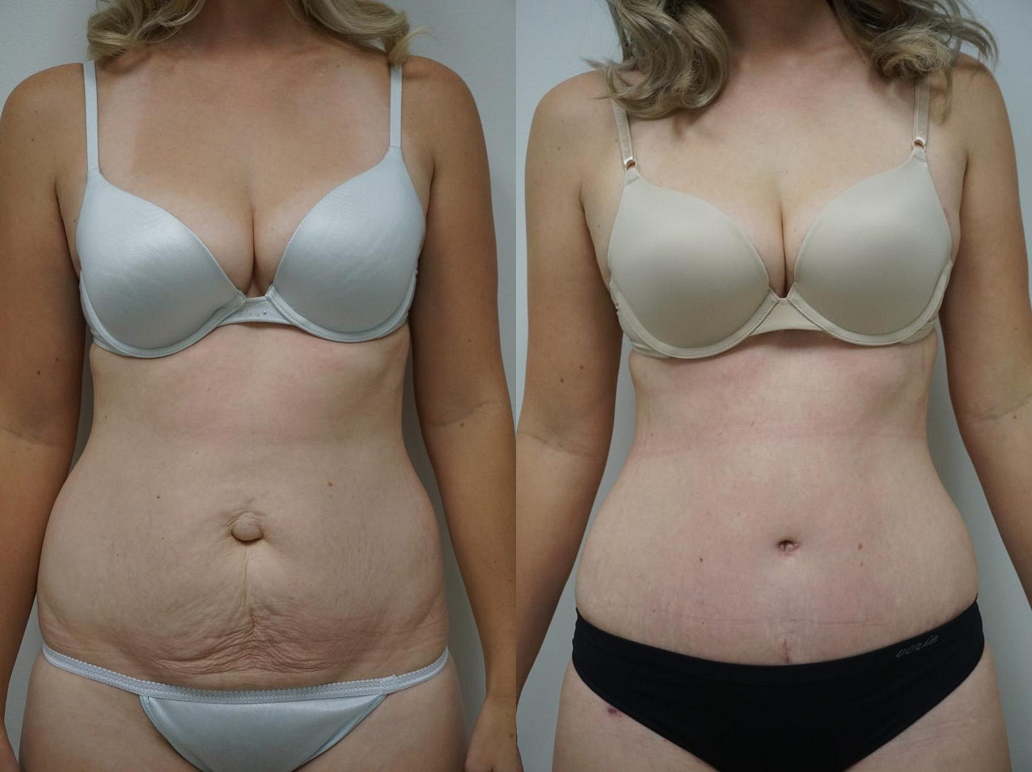 5 Unexpected Benefits of Tummy Tuck Surgery (Infographic) – Advanced  Plastic Surgery Institute With Dr. Josh Olson & Dr. Jacob Marks