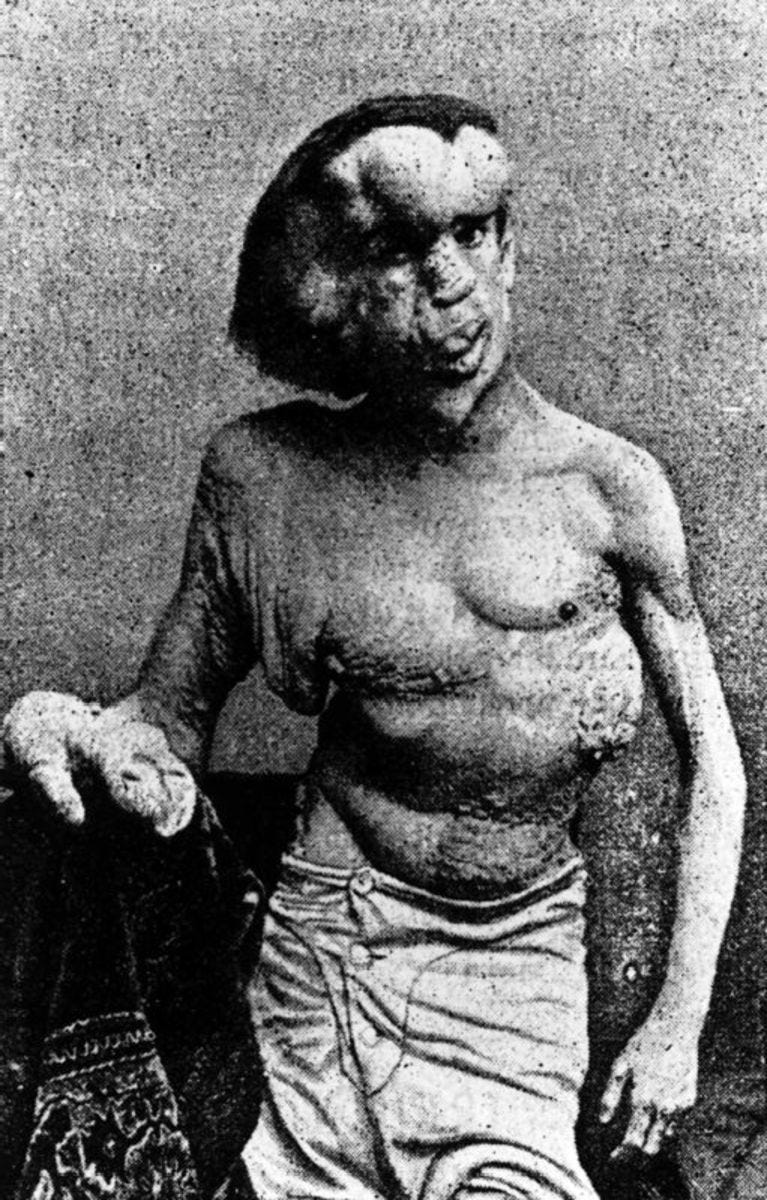 Actual photos of the Elephant Man