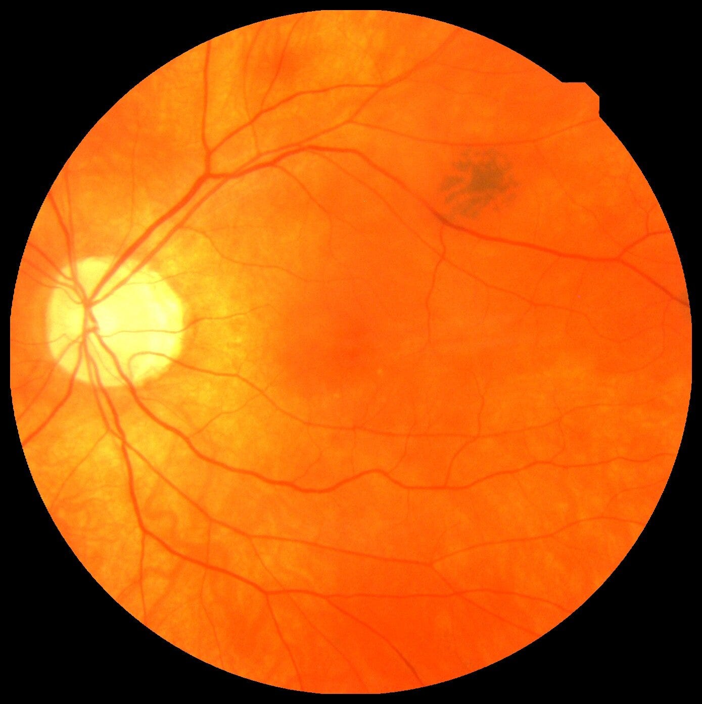 Using the eye as a window into heart disease