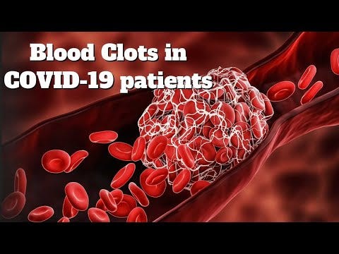 Irish scientists find the reason for blood clots in COVID-19 patients