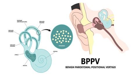 In Your Ear Crystals Symptoms