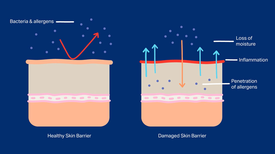 Skin Barrier Basics for People With Eczema | National Eczema Association