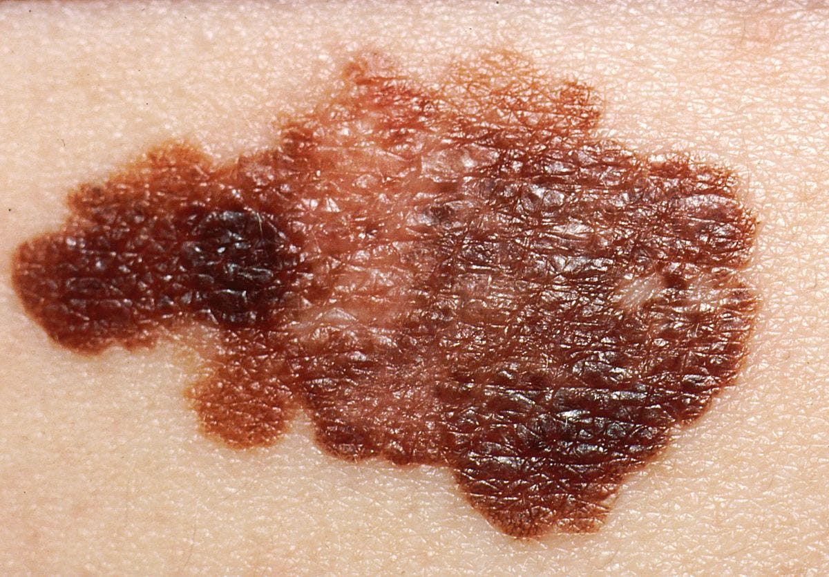 Melanoma Melanoma - Wikipedia