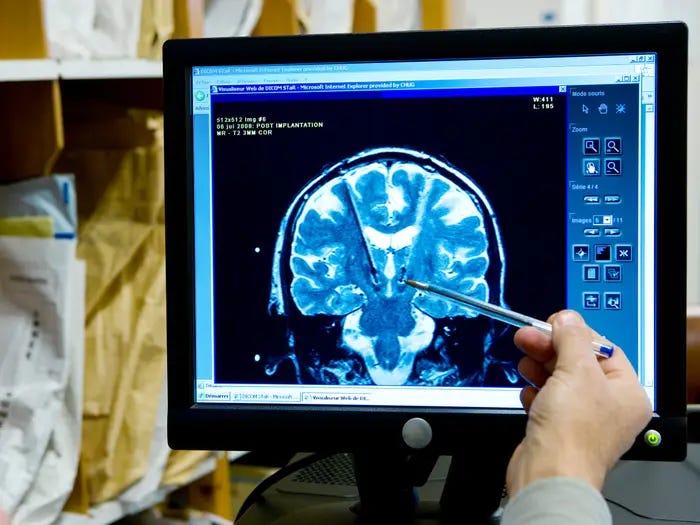 Ressonância Magnética de um Cérebro de um paciente de 30 anos com distonia