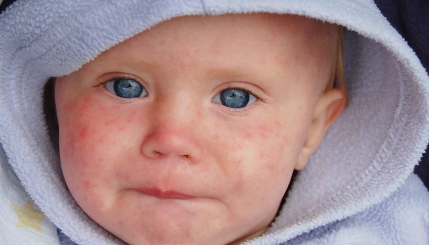 kid with measles