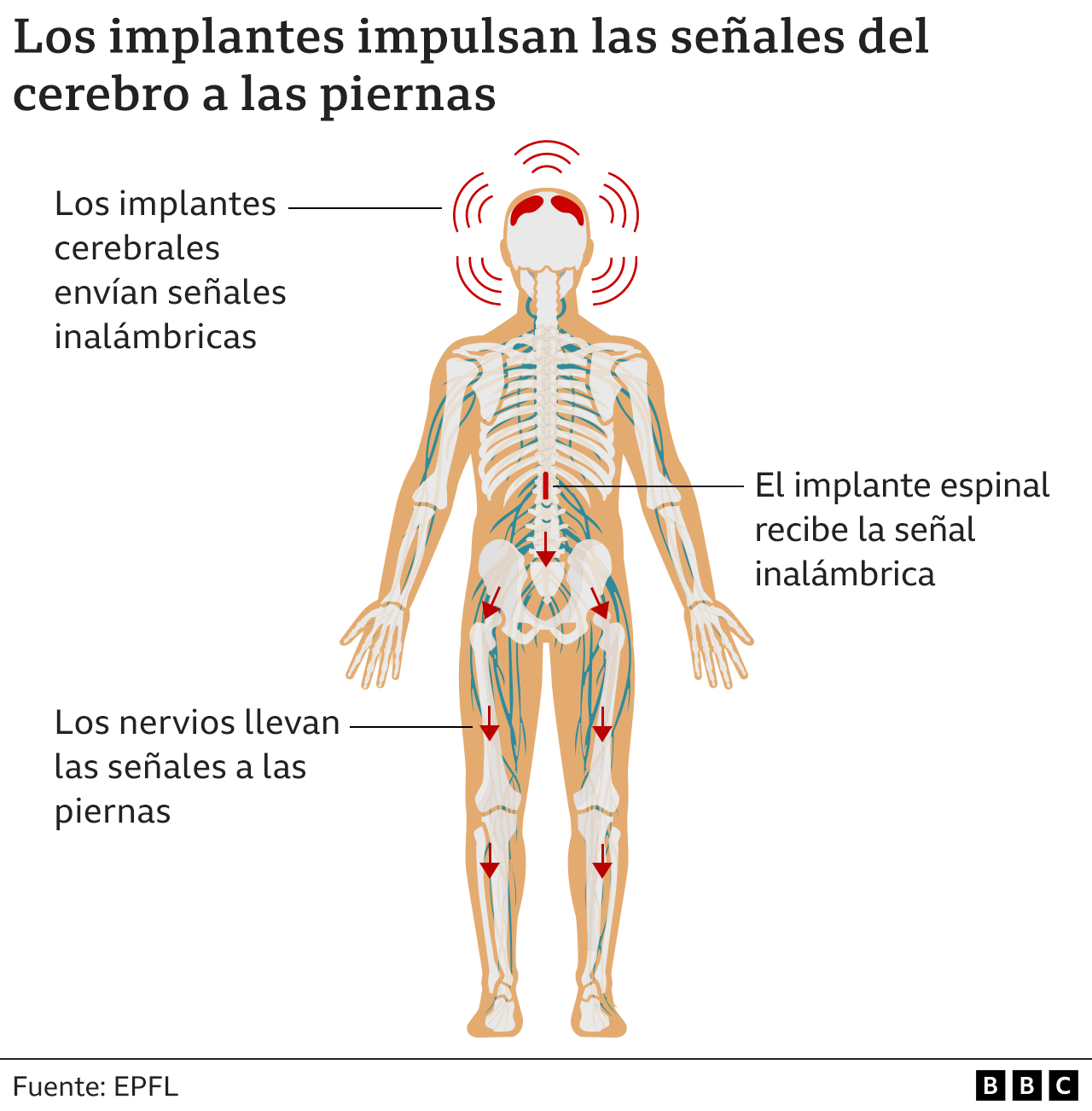 Ilustración de la BBC sobre el sistema de implantes