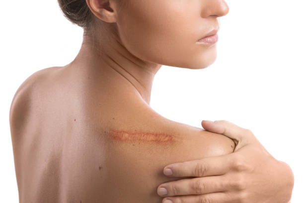 woman with a scar on her shoulder - skin diseas bildbanksfoton och bilder