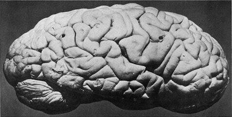 Black and white photograph of the right hemisphere of human brain with ruler measurement