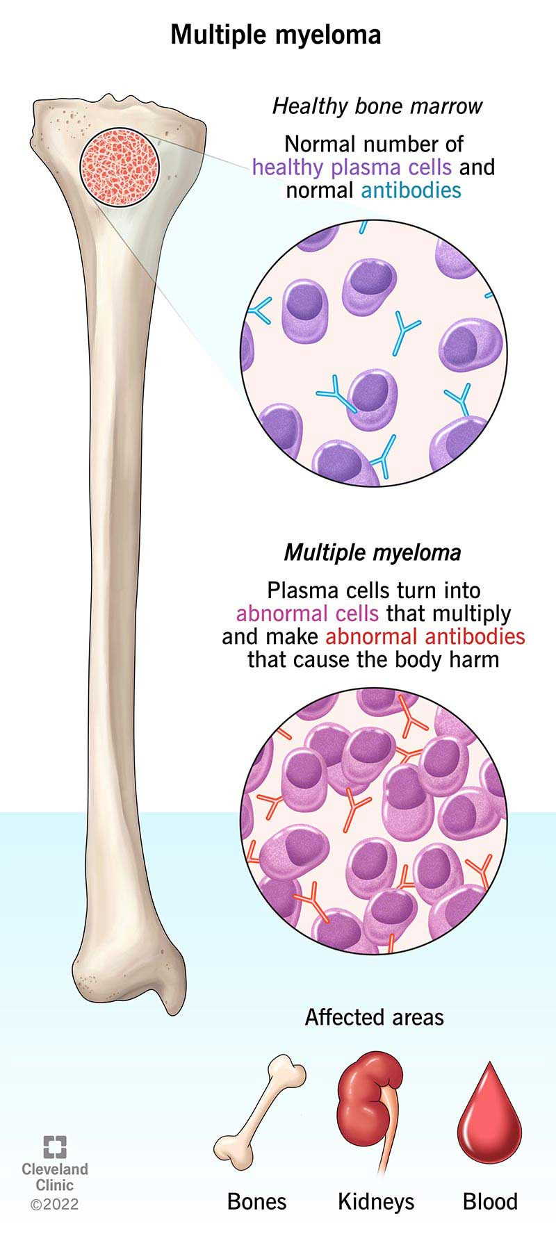 In multiple myeloma, healthy plasma cells that create infection-fighting antibodies become abnormal cells that multiply, damaging blood, bone and tissue. The abnormal plasma cells also create abnormal antibodies, called M proteins, that can cause heart and kidney issues.