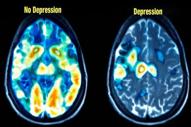 Taking depression seriously: What is it? | Wu Tsai Neurosciences Institute