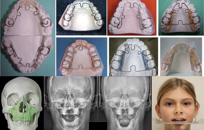 ALF Orthodontics: what it is - tooth-for-a-tooth.com