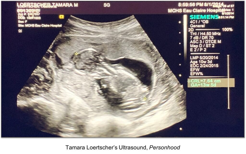 Personhood Alliance - Tamara Loertscher ultrasound