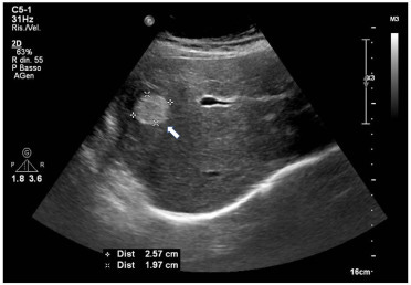 The case of a liver adenoma that looked like a hemangioma - ScienceDirect The case of a liver adenoma that looked like a hemangioma - ScienceDirect