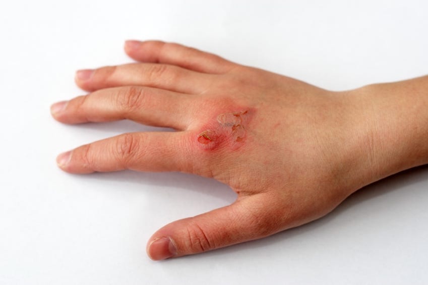 Infected Wounds: When to See a Doctor - Suncoast Urgent Care