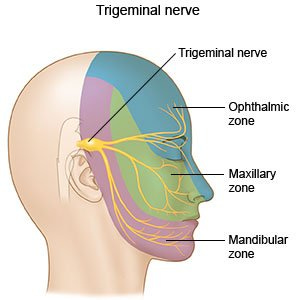 Trigeminal Neuralgia - What You Need to Know