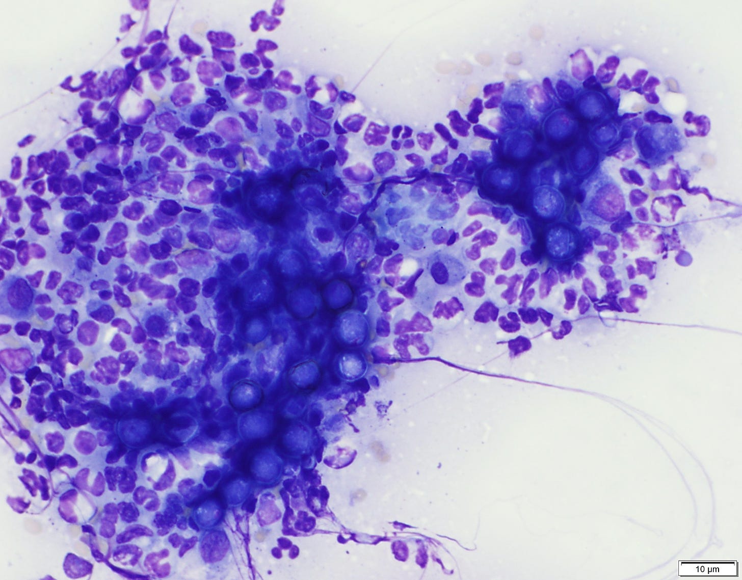 Blastomyces dermatitidis infection in a cat lymph node with neutrophilic inflammation