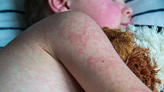 Child with measles has a red rash on arm lies on striped bed, hugging a brown plush toy. The setting is calm, and the mood appears restful. Child with measles has a red rash on arm lies on striped bed, hugging a brown plush toy. The setting is calm, and the mood appears restful.