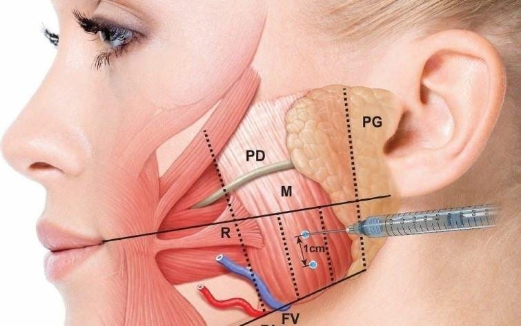 Botox for TMJ disorder - Hush LA Medspa