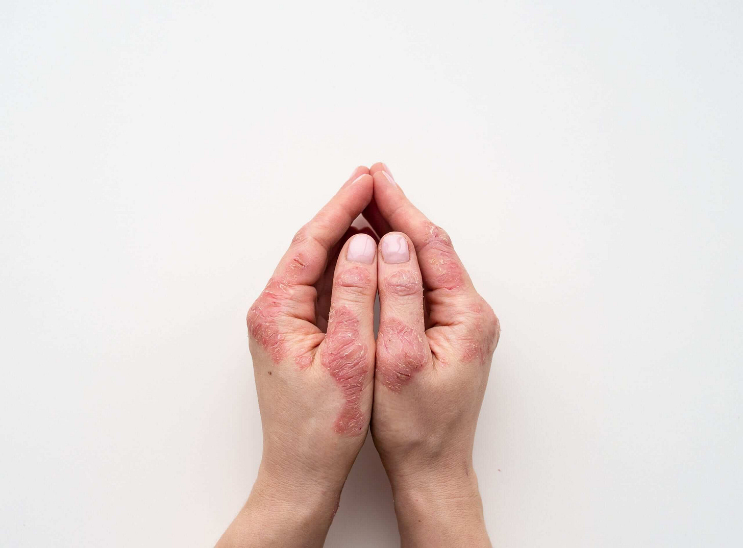 Psoriasi Mani: Sintomi da Non Sottovalutare e Rimedi da Applicare!