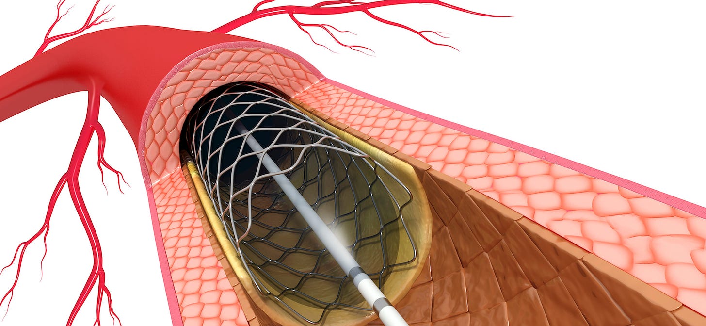 Percutaneous Coronary Intervention | Conditions & Treatments | UT  Southwestern Medical Center