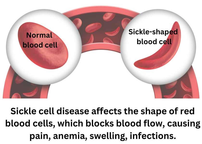 sickle cell disease image and explanation