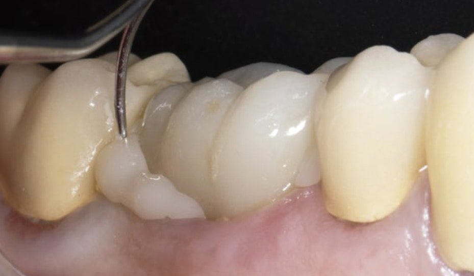 Cementation of lithium disilicate crown