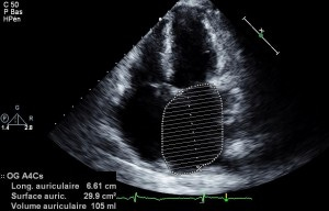 Cette magnifique oreillette gauche vous est offerte par Philippe, cardiologue auteur du superbe (et drôle) blog http://echocardioblog.com/