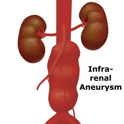 Abdominal aortic aneurysm - UF Health