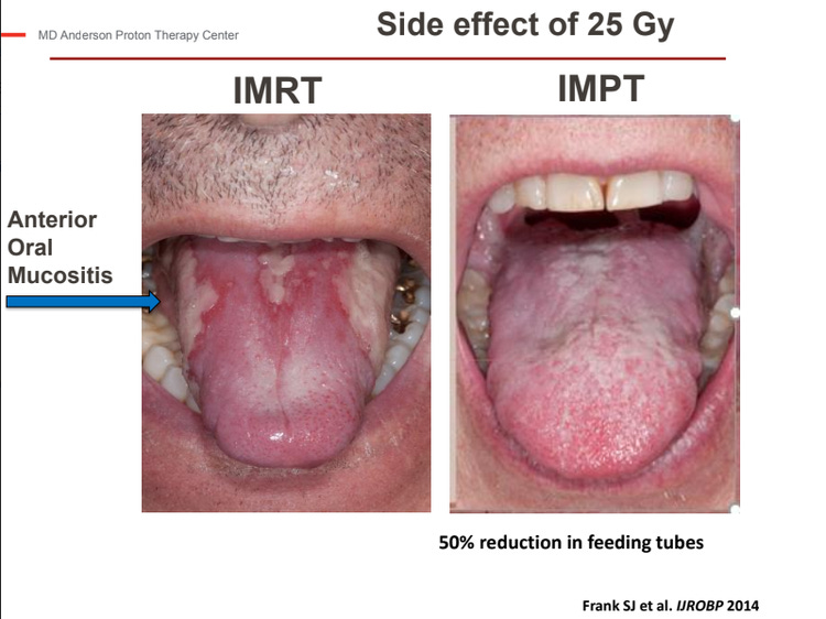 Picture showing oral cavity reactions with IMRT (left) and Proton Therapy (right) from radiation - published in 2014 Frank SJ.